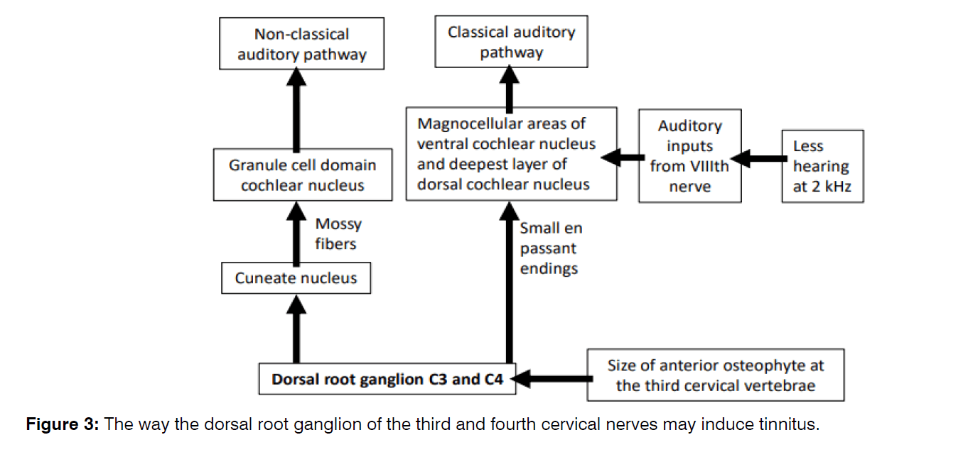 Tinnitus-root-ganglion