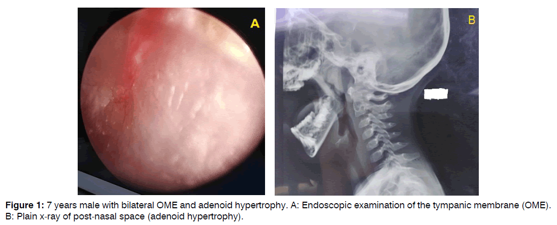 tinnitus-adenoid-hypertrophy