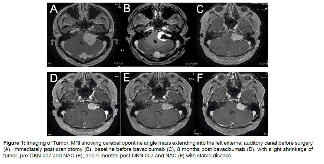 tinnitus-cerebellopontine-angle