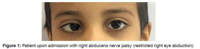 tinnitus-eye-abduction