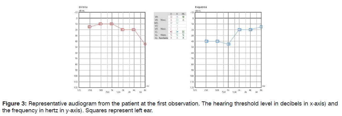 tinnitus-threshold-level