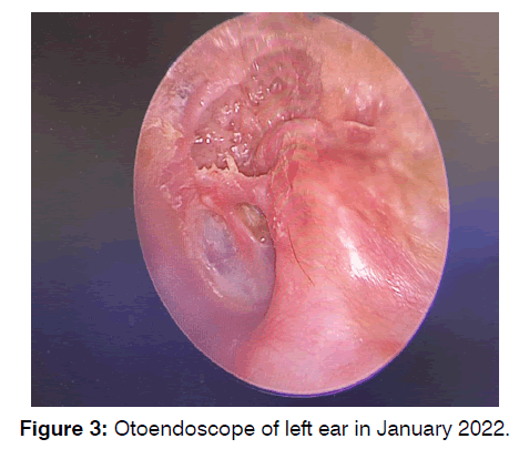 tinnitus-tone-audiometry