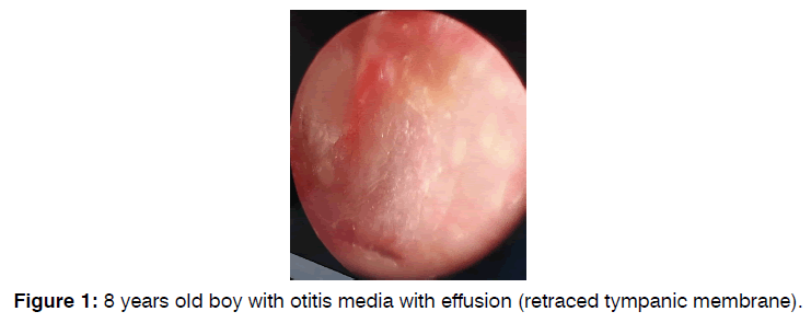 tinnitus-tympanic-membrane