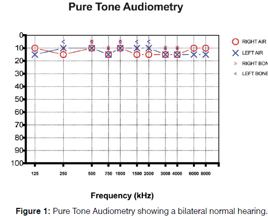 Tinnitus-Antinitus-Tone-Audiometry