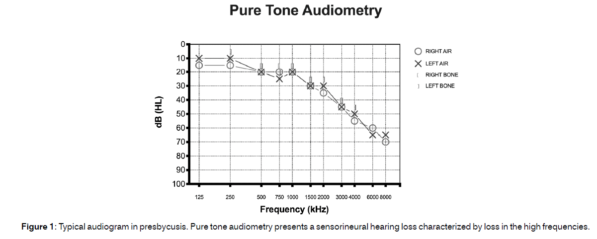 Tinnitus-Brazilian-Typical-audiogram