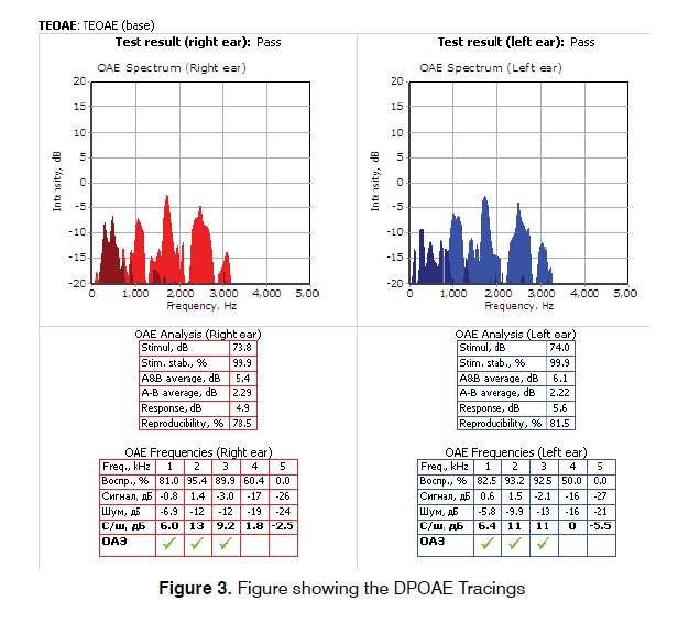 Tinnitus-DPOAE-Tracings