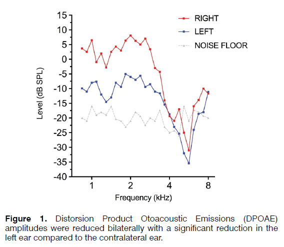 Tinnitus-Otoacoustic-Emissions