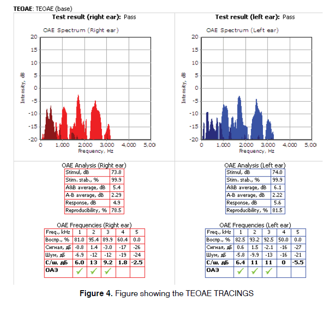 Tinnitus-TEOAE-TRACINGS