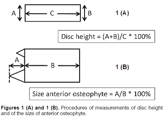 Tinnitus-anterior-osteophyte