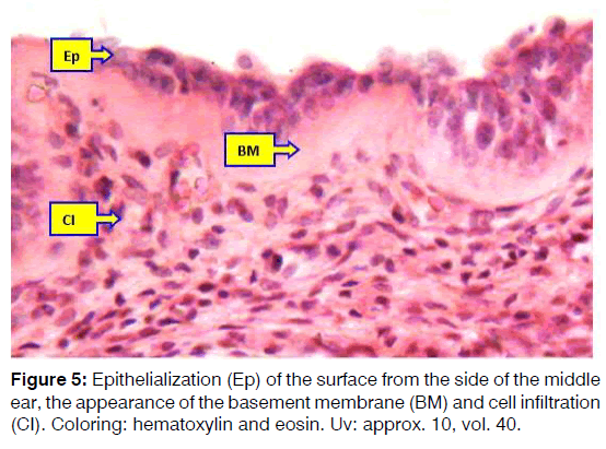 Tinnitus-apithelialization