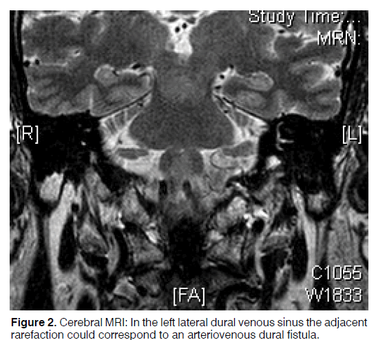 Tinnitus-fistula