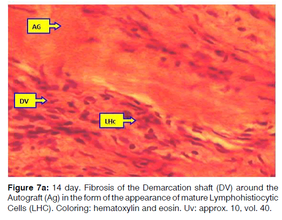 Tinnitus-mature-lymphohistiocytic