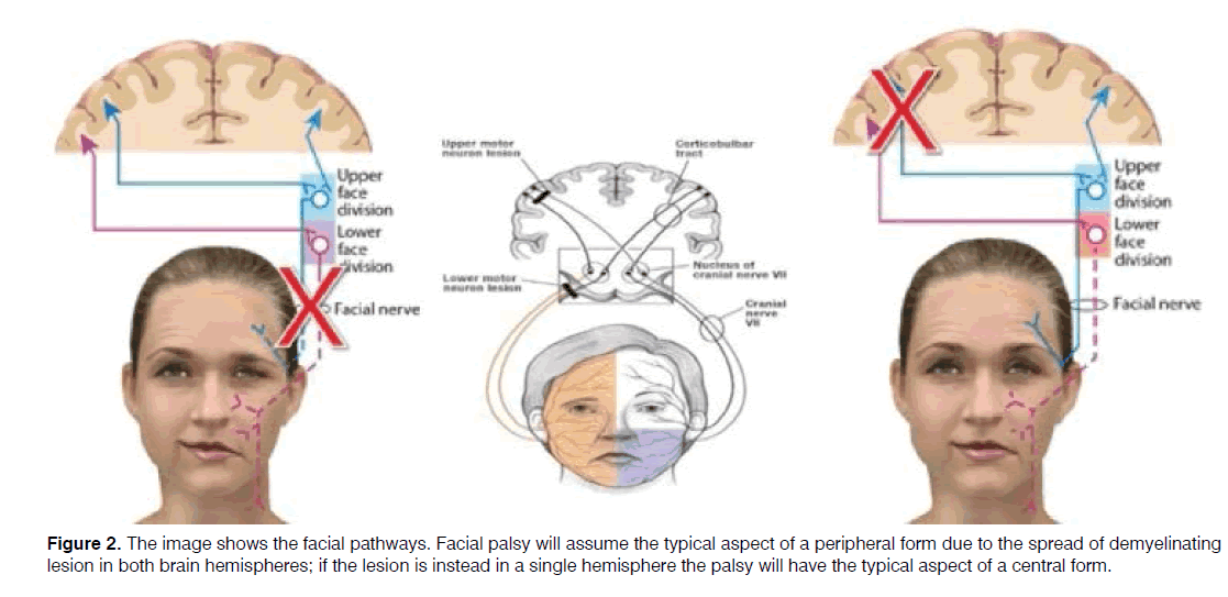 Tinnitus-peripheral