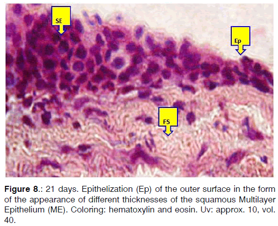 Tinnitus-squamous-multilayer