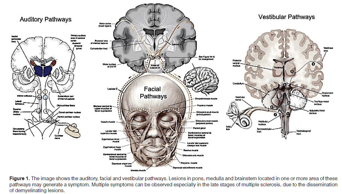 Tinnitus-vestibular