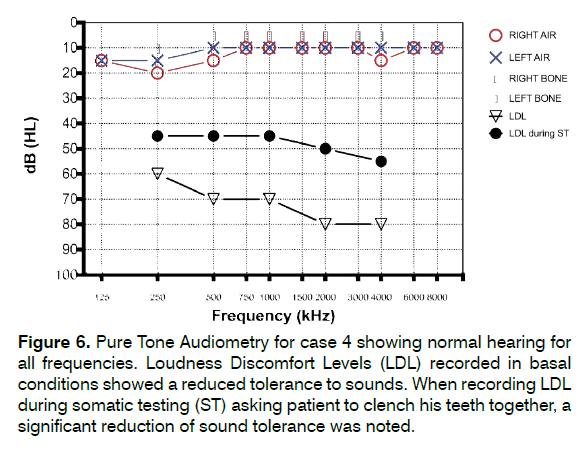 tinnitus-Loudness-Discomfort-Levels