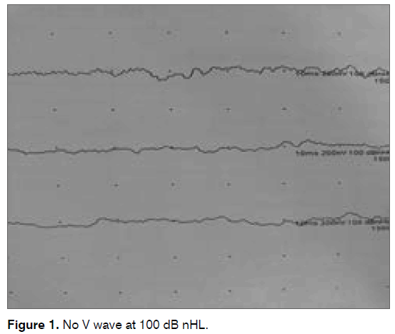 tinnitus-No-wave