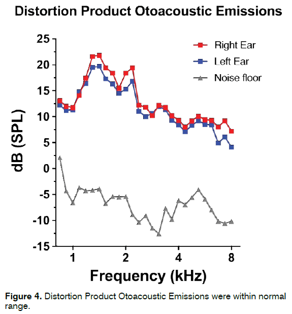 tinnitus-Product-Otoacoustic-Emissions