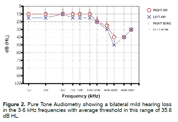 tinnitus-Pure-Tone-Audiometry