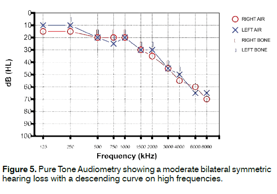 tinnitus-Pure-Tone-Audiometry