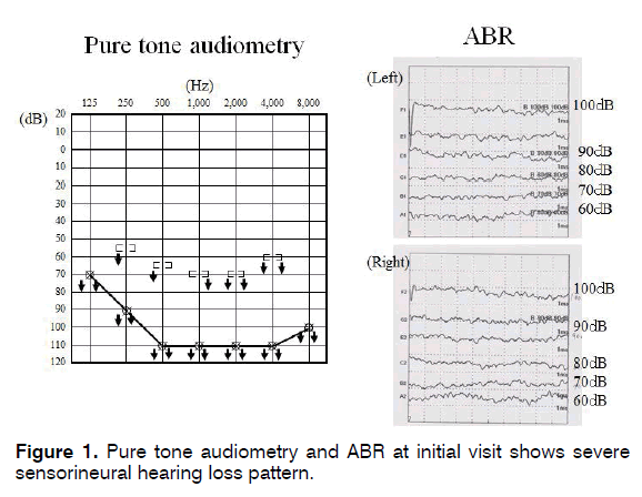 tinnitus-Pure-tone-audiometry