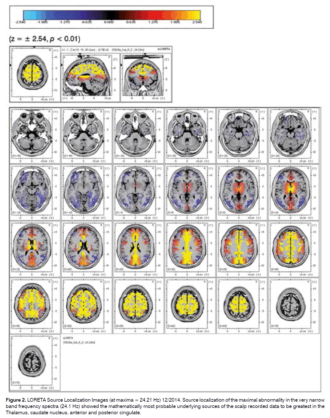 tinnitus-Source-Localization-Images