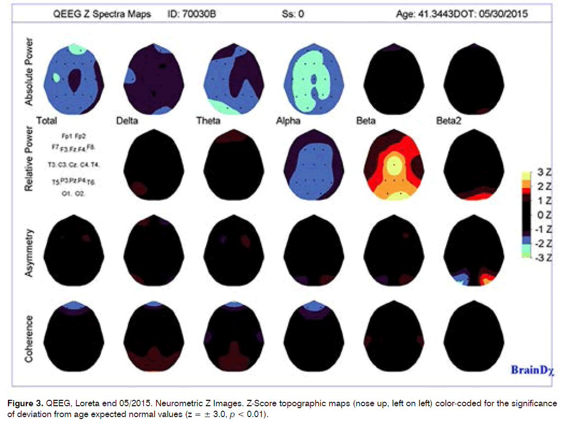 tinnitus-Z-Score-topographic