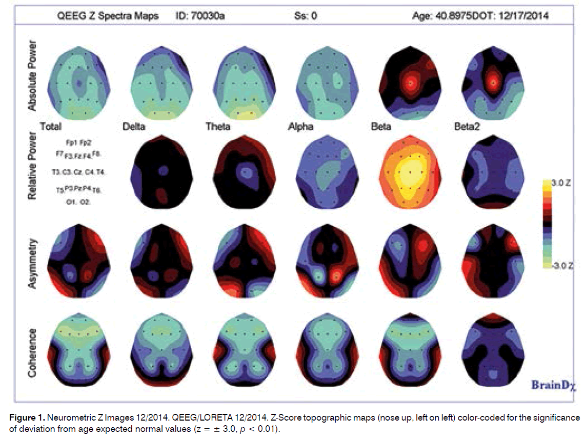 tinnitus-Z-Score-topographic-maps