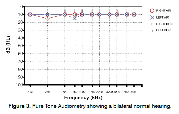 tinnitus-bilateral-normal-hearing