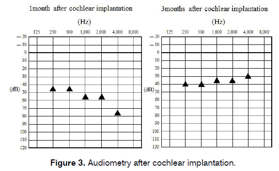 tinnitus-cochlear-implantation