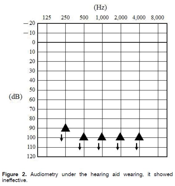 tinnitus-hearing-aid-wearing