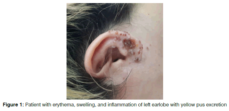 tinnitus-left-earlobe