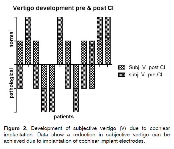 tinnitus-subjective-vertigo