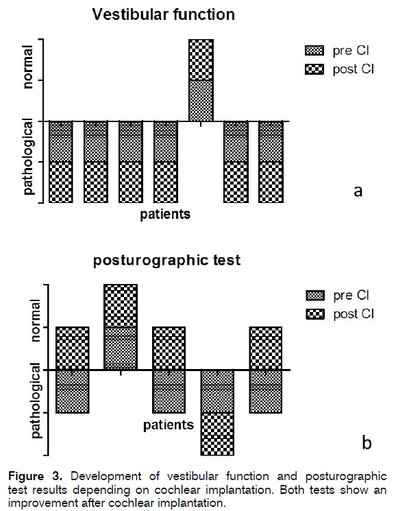 tinnitus-vestibular-function-posturographic