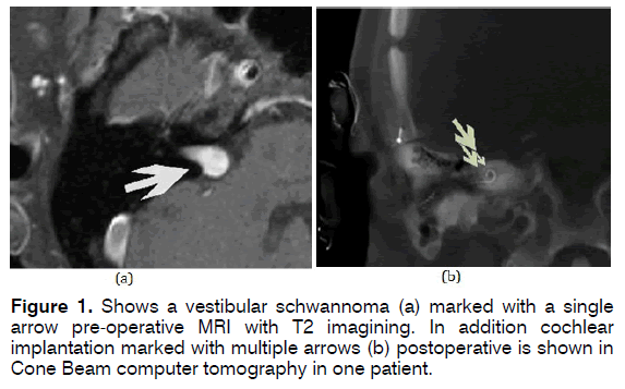 tinnitus-vestibular-schwannoma