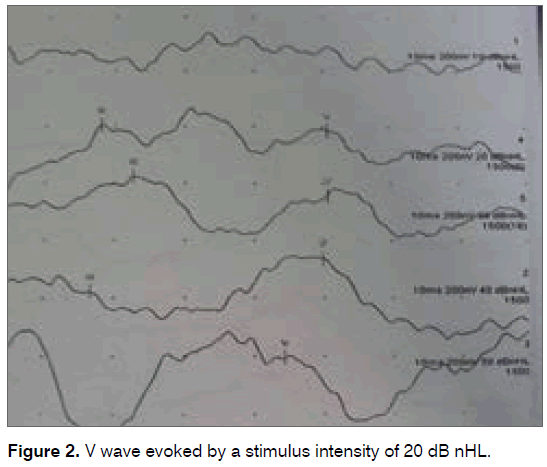 tinnitus-wave-evoked